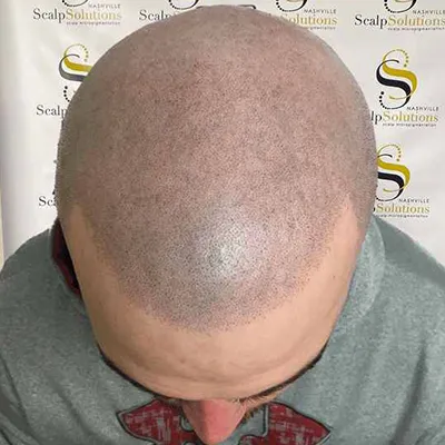 Scalp Micropigmentation | Male